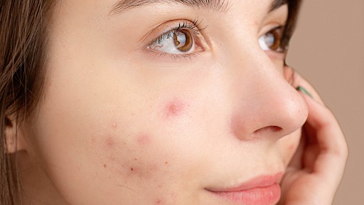 Is Shea Butter Or Cocoa Butter Better For Acne Prone Skin