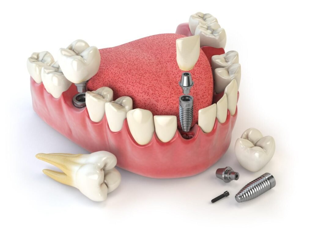 What Makes Dental Implants Long-Lasting